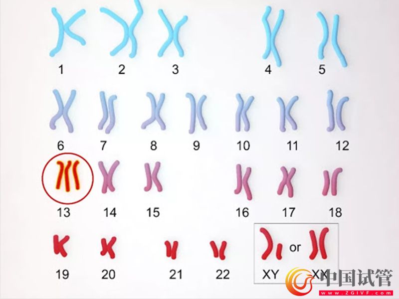 唐氏綜合征21號異常染色體引發(fā)的危害(圖1)