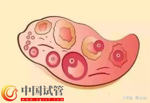 卵巢早衰卵泡不發育怎么辦？卵巢早衰可以借卵試管生孩子嗎？(圖7)