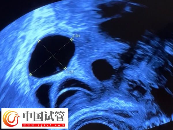 試管嬰兒促排卵期間多久做一次b超監(jiān)測(cè)卵泡發(fā)育？(圖1)
