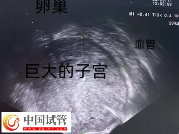 為什么41歲女人做試管嬰兒會失敗？背后真相大揭秘(圖2)