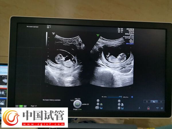 10個人做試管幾個能成功(圖2)