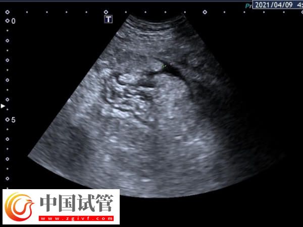 取完卵第幾天容易腹水(圖1)