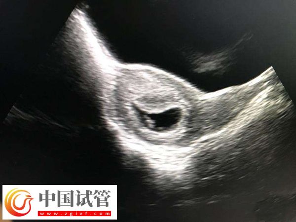 實施試管懷孕4個月穩不穩定(圖4)