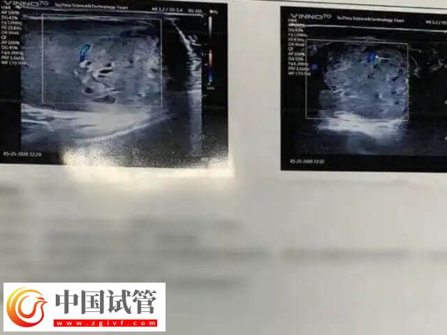 胚胎移植前如何調(diào)理內(nèi)膜(圖1) 胚胎移植前如何調(diào)理內(nèi)膜(圖1)