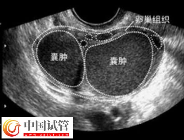 試管巧囊4cm影響著床(圖1)