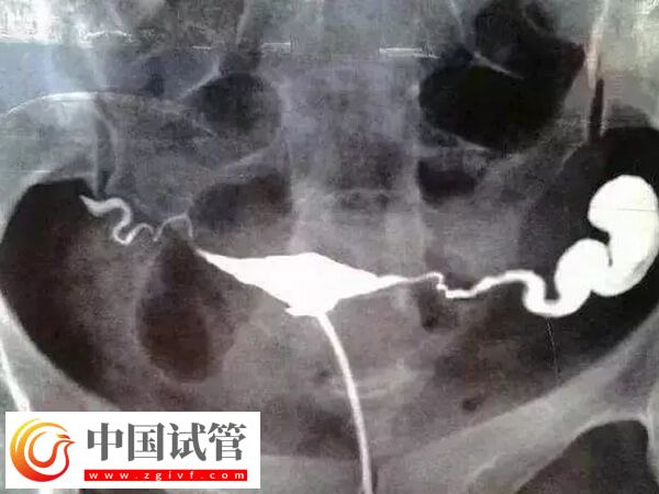 做試管輸卵管積水有沒有影響(圖1)