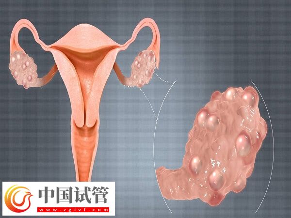 做試管輸卵管積水有沒有影響(圖2)