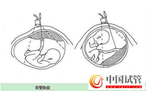1分鐘了解胎盤前壁和后壁的3大區別,為孕期做好準備(圖1) 1分鐘了解胎盤前壁和后壁的3大區別,為孕期做好準備(圖1)