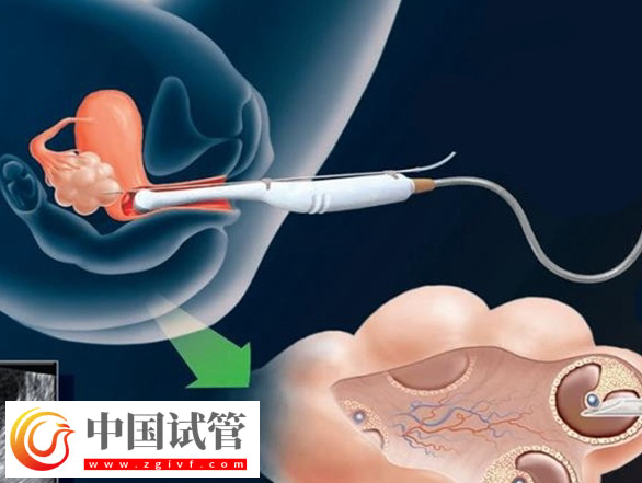 取卵手術(shù)要多少錢一次(圖1)