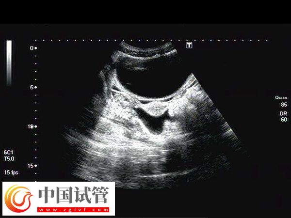 試管移植前子宮動脈阻力偏高打多久肝素(圖2)