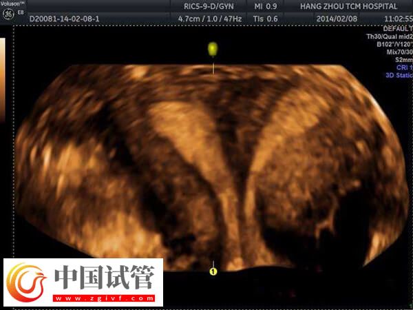 試管移植優(yōu)胚為什么會出現(xiàn)空囊(圖2)