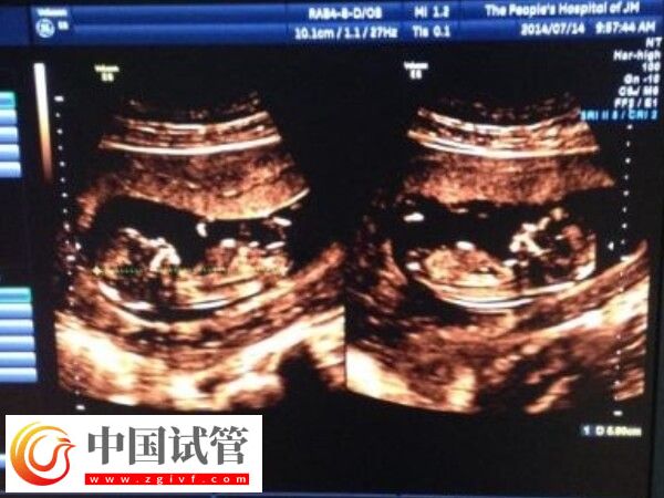 做試管懷雙胞胎減胎有沒有風險(圖1)