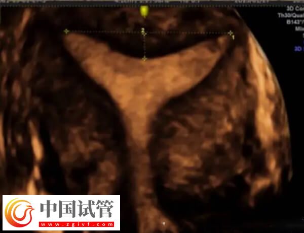 鮮胚移植后宮腔積液多久能吸收(圖2)