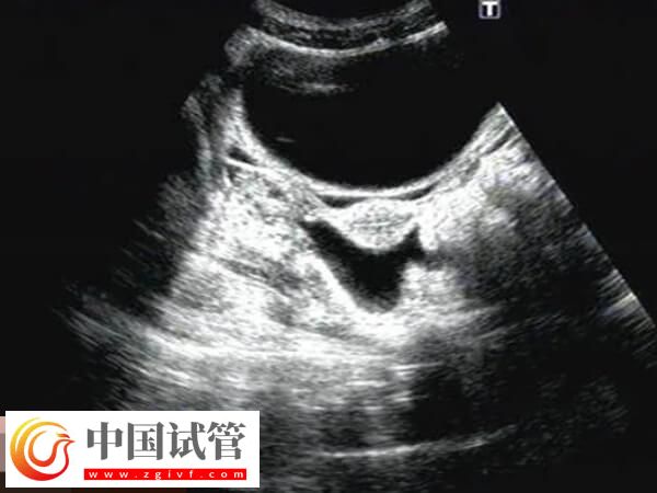 鮮胚移植后宮腔積液要注意，多久才能吸收一看便知(圖1)