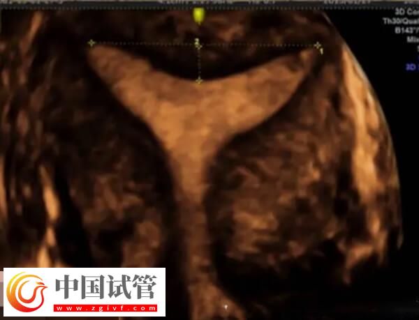 鮮胚移植后宮腔積液要注意，多久才能吸收一看便知(圖2)