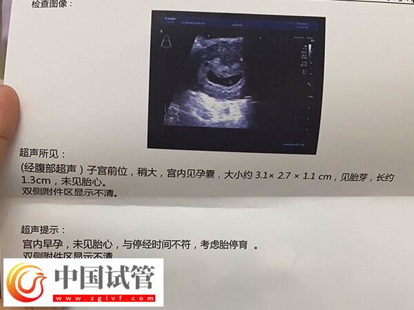 試管胎停育的前兆反應有哪些(圖1)