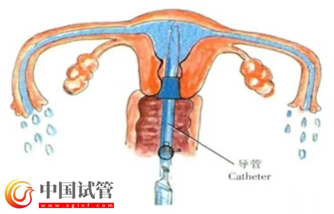 富血小板血漿PRP宮腔灌注后需注意3-7天內禁止同房嗎？(圖1)