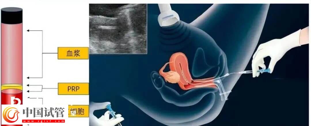 宮腔灌注具體的操作流程是怎么樣的？需要幾分鐘完成？(圖1)