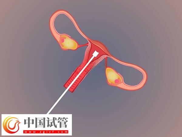 不經(jīng)中介去泰國(guó)做試管要怎么做(圖1)