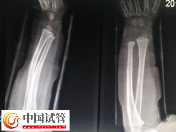 骨折愈合一年可不可以做試管(圖2)