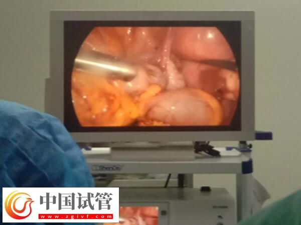 腹腔鏡子宮切除手術怎么做(圖5)