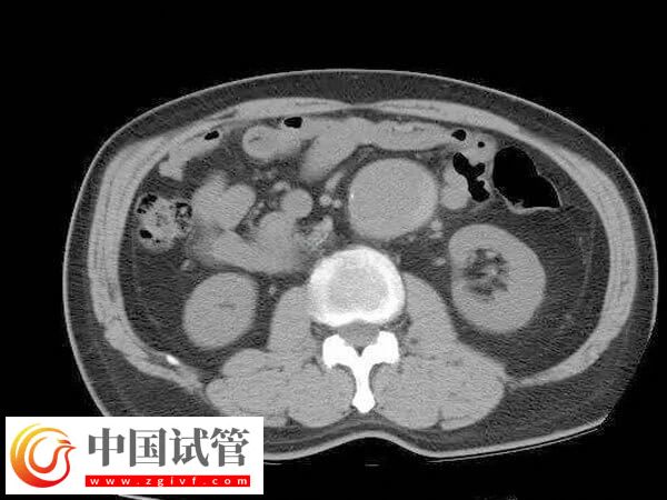 腹腔鏡子宮切除手術怎么做(圖3)