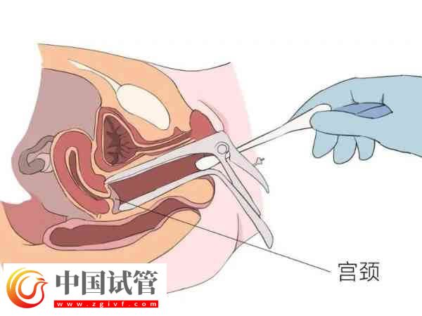 宮腔粘連是怎么引起的(圖1)