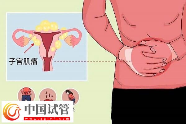 子宮肌瘤是什么原因?qū)е碌?？專家解讀子宮肌瘤的原因(圖1)